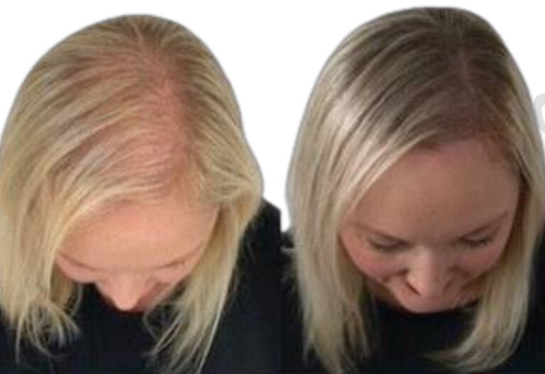 micro haar pigmentatie en dunnerwordend haar bij mhp westland in naaldwijk