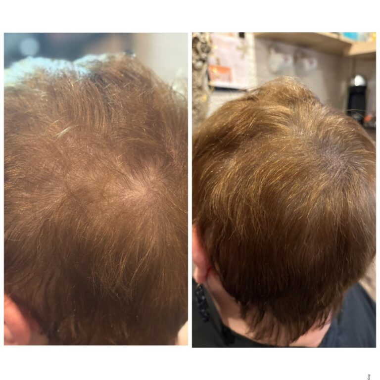 micro haar pigmentatie